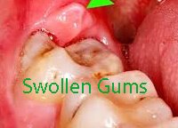 Dental Pro 7 For Swollen Gum Treatment